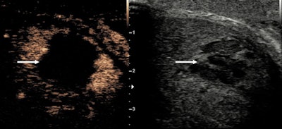 A hematoma within the corpora cavernosa, with contrast ultrasound examination confirming the avascular nature of the lesion, and the clear size and extent (arrows).