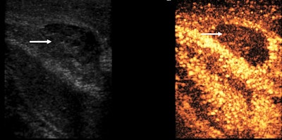A penile fracture with an avascular hematoma (arrow) on the contrast ultrasound examination, lying outside the tunica albuginea of the corpora cavernosa.