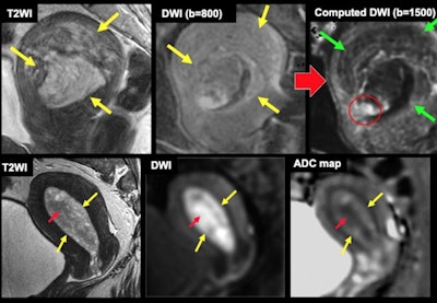Endometrial cancer in endometrial polyp (top row of three images): the cancerous focus is clarified due to signal decrease of polyp on high b values on computed diffusion-weighted imaging (DWI). Endometrial cancer in endometrial hyperplasia (bottom row of three images): the cancerous focus is well visualized as low apparent diffusion coefficient (ADC) area on ADC map. Red arrows = cancer. Yellow arrows = polyp/hyperplasia. Green arrows = signal decrease of polyp on high b values on computed DWI.