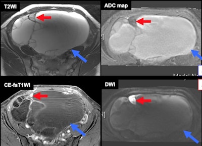 Metastasis within benign ovarian tumor. Some high-grade malignant tumors like serous tubal intraepithelial carcinoma (STIC) can metastasize to the ovaries or benign ovarian pathologies and mimic malignant transformation. Blue arrows = benign mucinous tumor. Red arrows = high-grade serous carcinoma. All images courtesy of Dr. Mayumi Takeuchi, Dr. Kenji Matsuzaki, and Prof. Masafumi Harada and presented at ECR 2023.
