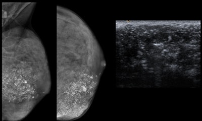 Breast cancer in an 18-year-old woman. A palpable lump can be seen on the mammogram. Dense breast (ACR D category) with regional fine pleomorphic and coarse heterogeneous calcifications. On ultrasound, a heterogeneous hypoechoic mass with irregular margins and hyperechoic calcifications is visible. The pathology is a comedo-type ductal carcinoma in situ (also known as comedocarcinoma in situ), a high-grade subtype of ductal carcinoma in situ.
