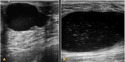 Simple cysts. (A) 13-year-old girl with a palpable lump. On ultrasound, it appears as an anechoic mass. (B) 15-year-old girl. Anechoic lesions with isolated echoes and mobile fluid level caused by debris.