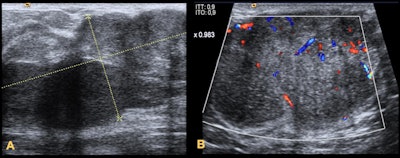 Juvenile fibroadenomas. A: Rapidly growing palpable lump in a 14-year-old girl. It appears on ultrasound as a circumscribed heterogeneous large mass. B: Palpable lump in a 13-year-old girl. It is visible on ultrasound as a circumscribed hypoechoic homogeneous mass. The lump is highly vascular on Doppler ultrasound. All images courtesy of Dr. Rosa Maria Lorente Ramos and colleagues and presented at ECR 2023.