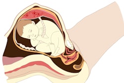 2023 04 12 03 14 7719 Fetus Breech 400