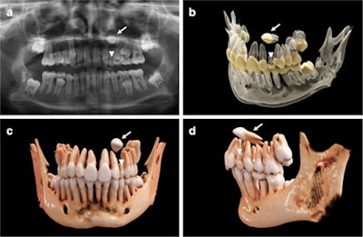 An 11-year-old girl with a horizontally impacted canine (white arrows) and a persisting deciduous canine (white arrowheads). (a) An x-ray of the girl's mouth. (b) Semitransparent reconstruction parameters are used to visualize bone, teeth, and different dental tissues. (c and d) The teeth and bone tissue with a soft kernel show a photorealistic visualization in both a frontal and lateral view.