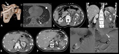 A 26-year-old male sustained a high-speed fall on his left side against rocks. 3D reconstructed CT image shows a distal third clavicular fracture (arrow in A). Axial CT image in lung window shows posterior rib fracture (arrow in B) and left anterior pneumothorax (asterisk in B). Contrast-enhanced CT images in axial (C, E, F) and coronal planes (D) show a wide laceration of the left kidney (asterisk in C and D) associated with perirenal hematoma (arrow in C), a contusion of the pancreatic tail (arrow in E), and a grade IV splenic injury (arrows in D, F). Angiography (G) performed on the same day shows inhomogeneous opacification of the spleen without any sign of active bleeding; main splenic artery embolization was performed with coils (H).