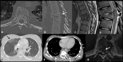 A 22-year-old female sustained a high-speed fall after a jump, during a competition. She presented with acute paraplegia. CT scan performed with polytrauma protocol (axial plane in A, sagittal plane in B with bony window) shows a burst fracture of T8 (with involvement of its left transverse process and with a posterior bone fragment displacement into the spinal canal, arrow in B), T9, and T10 vertebrae. A subsequent MRI obtained on the same day shows spinal cord compression (note the retropulsed bone fragment in contact with the spinal cord on axial T2-weighted image in G), spinal cord contusion that appears hyperintense on sagittal T2-weighted (C), and STIR sequence (D) and a posterior epidural hematoma (arrow in D). Thoracic CT scan shows a lung contusion (arrow in E) and bilateral pleural effusion (F).