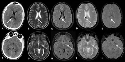 A 25-year-old male sustained direct head trauma due to a high-speed fall (forward, over the handlebars) after hitting an obstacle on the trail. He appeared sleepy and inattentive at the neurologic examination. Axial CT scan (A, F) shows a small hemorrhagic lesion in the splenium of the corpus callosum (arrow in A). A subsequent MRI scan obtained two days later confirmed the finding and showed other punctate lesions in the left basal ganglia that appear hyperintense on T2-weighted (B, G) and FLAIR sequences (C, H), and hypointense on gradient echo (D, I) and susceptibility-weighted sequences (E, L), suggestive of diffuse axonal injury lesions. All images courtesy of Dr. Raffaella Colantonio and colleagues and presented at ECR 2023.