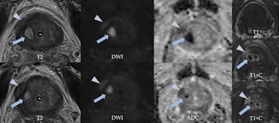 A 69-year-old man with urinary retention and recurrent prostatitis with chronic urinary catheter had a PSA of 3.79 ng/ml. MpMRI shows round, high signal intensity lesion on T2-weighted imaging in the right transitional zone (arrows), highlighting markedly restricted diffusion and 'ring' peripheral contrast uptake, consistent with a small abscess. A lenticular area is visualized in the right peripheral zone (arrowheads), showing characteristics of a PI-RADS 4 lesion (restricted diffusion and low T2 signal intensity, contrast uptake). However, malignancy was suspected due to mpMRI, and taking into account the accompanying findings, it was thought this might correspond to a phlegmonous area (prostatitis).