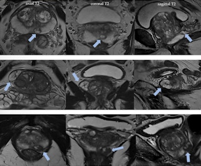 Benign prostatic hyperplasia nodules in the peripheral zone may mimic prostate cancer. Nodules with typically glandular type hyperplasia may appear in peripheral zone as ectopic or herniated nodules from the transition zone. It is important to analyze the morphology on T2-weighted imaging; look out for well-defined, rounded, encapsulated lesions; and identify the hyperintense component corresponding to hyperplastic glands with cystic ectasia. Figures courtesy of Dr. Daniel Vas et al and presented at ECR 2023.