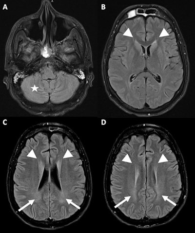 A 34-year-old man with a psychiatric history was found unconscious with heatstroke. FLAIR MRI sequence at the infratentorial level (A) with slight symmetrical cerebellar edematous changes collapsing the cerebellar leaflets (star), and supratentorial slices at the level of the lateral ventricles (B), corona radiata (C), and semioval centers (D), showing edematous changes of both caudate nuclei with collapse of both frontal horns (arrowhead) and slight increase in the signal of the biparietal periventricular white matter (arrows).