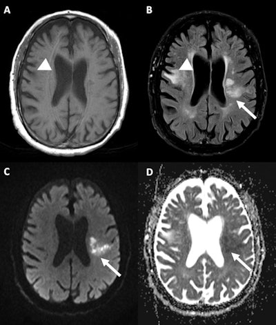 A 77-year-old male patient was found unconscious in a state of dehydration and hyperthermia. MRI shows old right frontal cortico-subcortical infarction (arrowhead) on T1-weighted (A) and T2-weighted imaging (B), with new acute posterior left frontal subcortical infarct (arrow) confirmed on diffusion-weighted imaging (C) and apparent diffusion coefficient map (D) sequences. Images courtesy of Dr. Camilo Pineda Ibarra et al. and presented at ECR 2023.