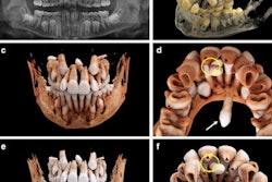 2023 04 19 17 17 6408 2023 04 12 Cr Teeth Image 3 Resized 400