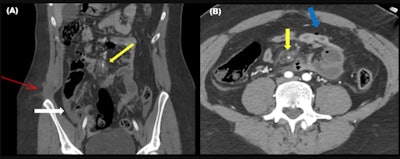 Bowel and mesenteric injury. CT signs of bowel damage consisting of pneumoperitoneum (blue arrow in B) and mesenteric damage consisting of hemoperitoneum and active bleeding (yellow arrow). There is also hypoenhancement of ileal loops (white arrow). Note the subcutaneous fat stranding (red arrow in A).