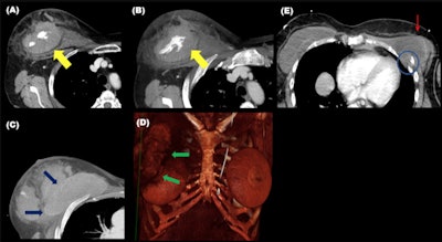 Chest wall injury. (A-D) show a patient with breast hematoma with active bleeding (yellow arrows), with mass effect over the right breast implant. Note the implant's surface in C (blue arrows) and D (3D reformation). (E) Breast implant rupture and an underlying rib fracture (blue circle).