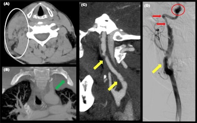 Blunt cerebrovascular injury. Patient after a motor vehicle collision and with seat belt sign. On initial CT exam, a right cervical hematoma (A) and first left rib fracture (B) were seen. The neck CT scan revealed a right carotid dissection. Angiography (D) shows the dissection (yellow arrow) and a superior segment with stenosis due to a subintimal hematoma (red arrow), and a pseudoaneurysm (red circle).