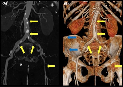 Seat-belt aorta. 3D maximum intensity projection reformation (A) and vascular 3D reformation (B) of a patient with abdominal aortic dissection. The beginning of the dissection is in the L3-L4 level, which is typical in a case of seat-belt aorta. It extends until the left femoral artery. There was also a pelvic ring fracture (blue arrows). All figures courtesy of Hospital Universitario 12 de Octubre and presented at ECR 2023.