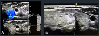 In an online poster presentation at the ARRS annual meeting, researchers led by Dr. Leila Aghaghazvini found that elastography and vascularity measures can help improve the performance of TI-RADS in assessing suspicious thyroid nodules. In these images, gray-scale features show a markedly hypoechoic thyroid nodule with irregular margins (TI-RADS 4), later confirmed as papillary thyroid cancer. (A) Elastography shows a mostly blue pattern. (B) Doppler sonography did not show any flow pattern. Images courtesy of the ARRS.
