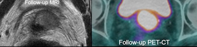 MRI performed five months later showed local relapse. PET/CT confirmed this and showed no distant disease. Patient underwent salvage pelvic exenteration and was disease-free two years later.