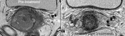 40-year-old LACC patient with stage B disease, node negative. Indeterminate residual T2-weighted signal change post CRT -- grade 3 (moderate response).