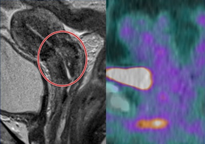 Indeterminate residual T2-weighted signal change post CRT -- grade 3. No corresponding residual metabolic activity on PET/CT -- grade 1 (complete metabolic response). Patient remains disease-free three years later.