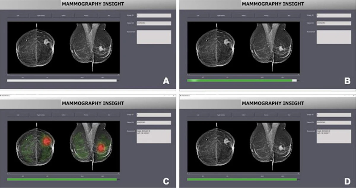 Breast radiologists impacted by automation bias when using AI
