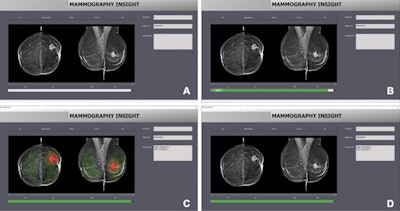 Interface of the AI-based diagnostic system shows (A) loading a new mammogram, (B) performing the image evaluation, (C) displaying the results of the image evaluation via a heat map, and (D) displaying the results of the image evaluation with the heat map turned off. Images courtesy of RSNA.