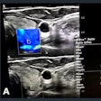 2023 05 02 15 17 0915 2023 05 02 Arrs Elastography Thyroid 20230502155832
