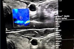 2023 05 02 15 17 0915 2023 05 02 Arrs Elastography Thyroid 20230502155832