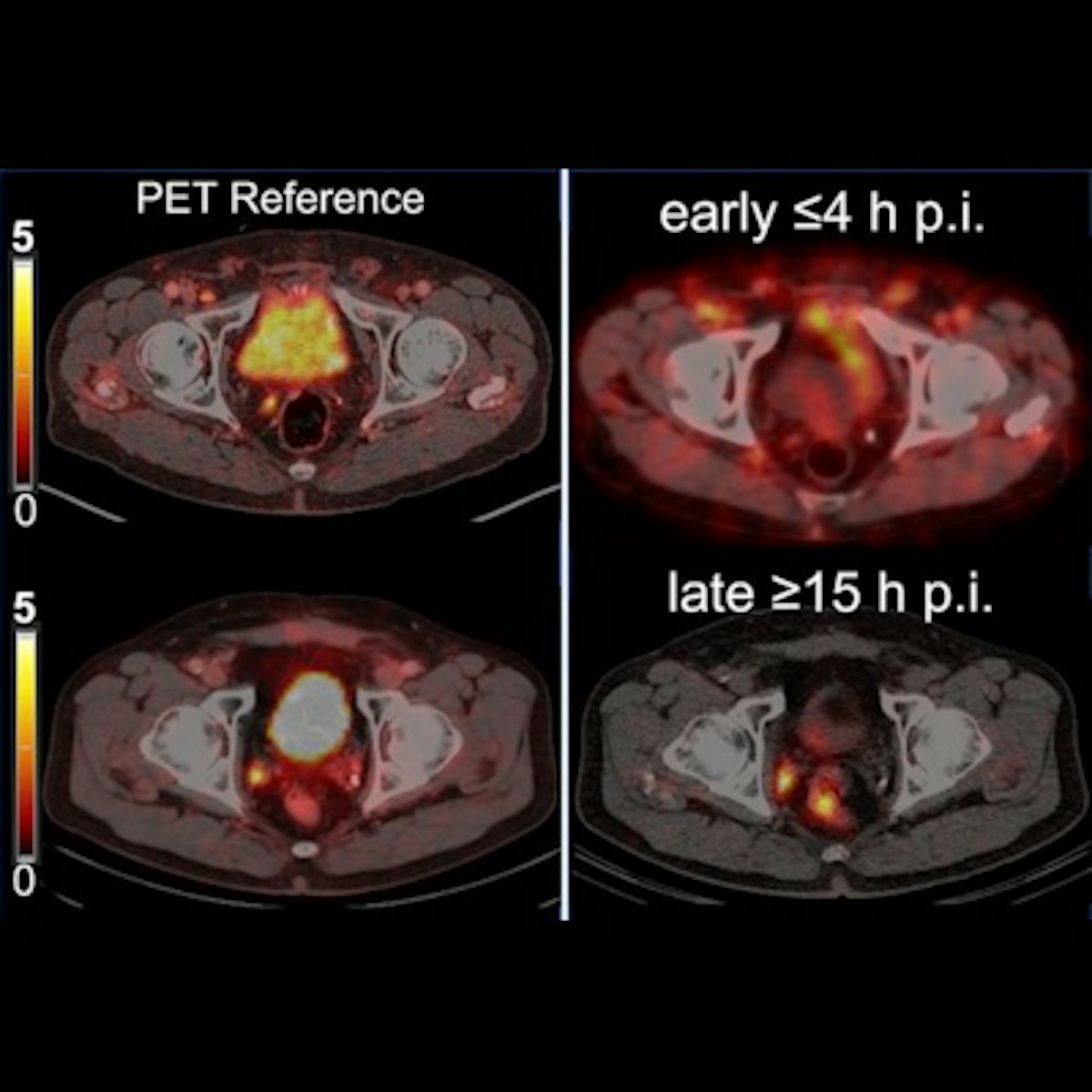 Delayed use of SPECT/CT can improve prostate cancer detection ...