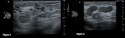 Another challenging case of breast cancer in a younger woman. Figure 5 (above, left) demonstrates nodular low echogenicity in a segmental distribution on ultrasound in the right upper inner quadrant, the extent of which was difficult to quantify on ultrasound. In Figure 6 (above, right), right axillary ultrasound demonstrates multiple abnormal axillary lymph nodes. In Figure 7 (below), MRI in the same patient shows segmental nonmass enhancement in the upper inner right breast demonstrating extent of disease measuring 82 mm in anteroposterior (AP) projection.