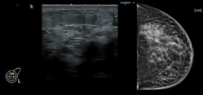 Cases of breast cancer in young women can be challenging to diagnose using ultrasound. (Left) Ultrasound image of left breast demonstrates diffuse skin thickening and subtle low echogenicity within the underlying parenchyma thought to represent mastitis. (Right) When symptoms failed to respond to antibiotic therapy, a mammogram was performed, which demonstrated diffuse pleomorphic microcalcifications throughout the left breast over at least 14 cm in transverse extent. Findings are suggestive of diffuse DCIS. All images courtesy of Dr. Molly Godson Treacy and Dr. Sylvia O'Keeffe and presented at ECR 2023.