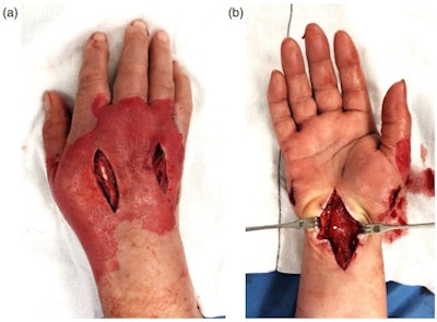 (A) Fasciotomy incisions to the dorsal compartments of the hand. (B) Fasciotomy incisions on the palmar aspect of the hand, demonstrating release of the thenar and hypothenar spaces as well as median nerve decompression through extended carpal tunnel release.