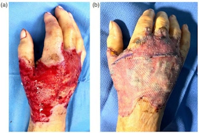 (A) Dorsal right hand following debridement or dead skin and closure of fasciotomy wounds. (B) Dorsal right hand with split skin graft reconstruction.
