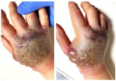 Acute compartment syndrome developing on the dorsum of the right hand. Note discoloration and blistering of the skin on the dorsum of the hand. All images and captions courtesy of ANZ Journal of Surgery through Creative Commons Attribution 4.0 International License.