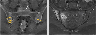 A 39-year-old woman with ankylosing spondylitis. Erosions surrounding the sacroiliac joints (yellow arrows), which are structural lesions pointing to chronic damage, are conspicuously revealed on the CT-like ZTE MR image (left), whereas the STIR MR image (right) superbly shows periarticular osteitis (asterisks) consistent with active sacroiliitis. White arrow showing the L5-S1 intervertebral disk space on the left image points to a pitfall of the ZTE sequence: Gas within joint spaces and soft tissues gives the false appearance of calcifications. Nevertheless, MRI with the ZTE sequence that produces CT-like images affords one-stop imaging in many musculoskeletal conditions obviating the need for additional ionizing radiation-based examinations. Figure courtesy of Üstün Aydingöz, MD, Hacettepe University, Ankara, Turkey.