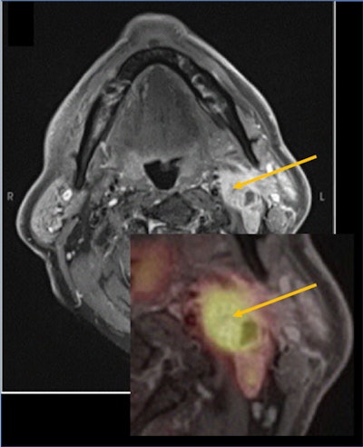 Metastatic lymph nodes in head and neck squamous cell carcinoma with contrast enhancement and high standardized uptake value (SUV). Figure courtesy of Dr. Nadya Pyatigorskaya, PhD, and presented at ISMRM 2023.