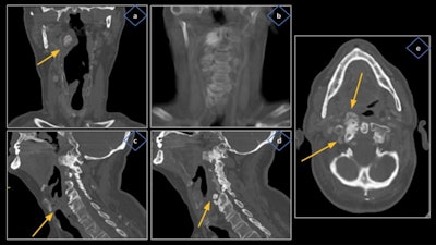 Cervical osteoarthritis caused right vocal cord paralysis (VCP) in a 69-year-old man. Thoracic images revealed severe degenerative changes of the cervical spine, especially at the level of: the soft palate, affecting the right atlantoaxial joint in the form of sclerosis, hypertrophy, and large osteophytes (a, b) projecting anteriorly with bulging of the airway (a) and occupation of the right parapharyngeal fat (e); and the cricoid ring, affecting the right uncovertebral joint of C5-C6 with an anterior osteophyte (d) that displaces the prevertebral muscles and reduces such space (c). All figures courtesy of Department of Radiology, Hospital del Mar -- Parc de Salut Mar, Barcelona, and presented at ECR 2023.
