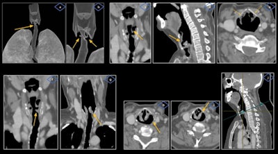 Internal bilateral laryngoceles led to left VCP in a 64-year-old woman with a history of smoking and chronic obstructive pulmonary disease. She was referred to the otorhinolaryngologist because of chronic dysphonia and dysphagia. Laryngoscopic evaluation showed left VCP. A contrast-enhanced neck CT revealed the presence of bilateral air-filled lesions (more prominent on the left side) located at the level of laryngeal ventricles (a-d), inside the paraglottic space bound by the thyroid cartilage (e). Also visible are signs of left VCP with asymmetric enlargement of both pyriform sinuses, with left side predominance (h) and anteromedial rotation of left arytenoid cartilage and vocal cord displaced medially (g, i), disclosing the 'pointing' sign on coronal view (f) and the 'sail sign' (*) on axial oblique plane (j).