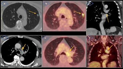 Stage III non-small cell lung cancer caused left VCP in a 71-year-old man with history of smoking and asbestos exposure, presents with five months of dysphonia with weight loss. Laryngoscopy showed signs of left VCP. Cervicothoracic contrast-enhanced CT was performed revealing a solid pulmonary nodule located in the periphery of left upper lobe (a) and a large mediastinal conglomeration of lymphadenopathies located at the left paratracheal station (d), probably injuring the course of left recurrent laryngeal nerve at the aortopulmonary window (c). PET/CT showed intense metabolic activity of the solid nodule and adenopathic conglomerate (b, e, f).