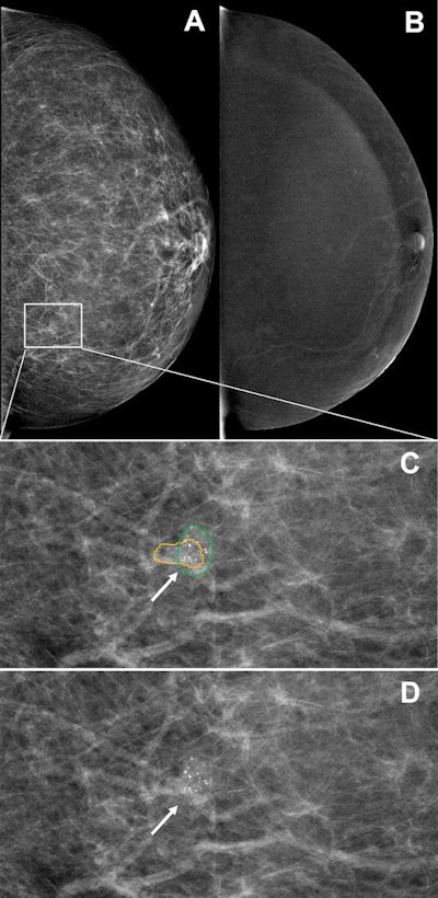 Example images show contrast-enhanced mammograms of a correct finding of suspicious calcifications by the deep-learning model. (A, C, D) Low-energy images in the left breast of a 58-year-old woman show a small cluster of fine calcifications (outlines [green for ground truth, yellow for prediction] in C; arrows in C and D) detected by the deep-learning model, with subtle nonmass enhancement at the site of the calcifications on the (B) recombined image. Subsequent stereotactic vacuum-assisted core-needle biopsy showed ductal carcinoma in situ (DCIS). Images and caption courtesy of RSNA.