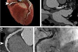 2023 06 26 00 15 6631 2023 06 20 Pcct Cardiac 20230626004046