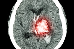 2020 06 02 23 08 0038 Ct Brain Stroke 400