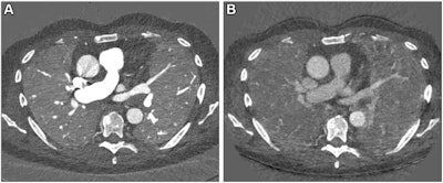 Images in a 67-year-old male patient with slowly progressing idiopathic pulmonary fibrosis. The axial images show differences in the perfusion images generated with (A) photon-counting CT (PCCT) versus (B) standard dual-energy CT. The dose was slightly lower with PCCT (inspiration and expiration, respectively: CT dose index, 3.26 and 3.27 mGy; dose-length product, 126 and 128 mGy∙cm) versus dual-energy CT (inspiration and expiration, respectively: CT dose index, 4.52 and 3.28 mGy; dose-length product, 167.6 and 121.5 mGy∙cm). The technical advancement of PCCT results in improved spatial and contrast resolution. The faster spectral imaging of PCCT also allows for CT pulmonary angiography in addition to a stable, uniform parenchymal contrast. Furthermore, the morphologic images can be reconstructed with high spatial resolution (1024×1024). Images and caption courtesy of the RSNA.