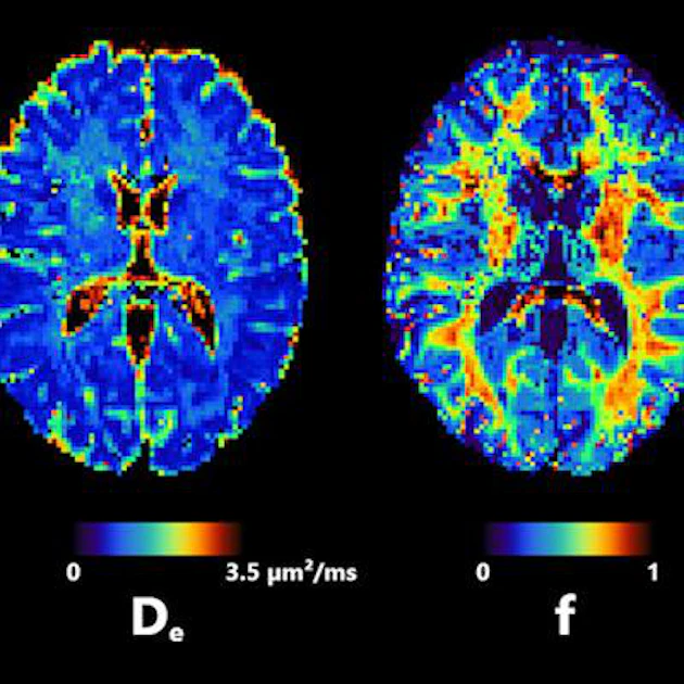 Novel diffusion MRI technique illuminates neurological disorders ...