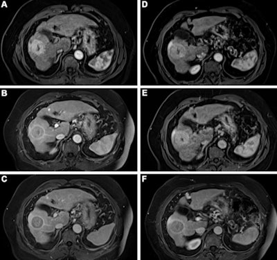 Contrast-enhanced MRI of the liver after administration of gadopiclenol (0.05 mmol/kg) and gadobutrol (0.1 mmol/kg). Axial 3D T1-weighted dynamic contrast-enhanced MRI scans during the (A, D) arterial, (B, E) portal venous, and (C, F) delayed phases in a 66-year-old man with hepatocellular cancer. Images were obtained after administration of gadopiclenol at 0.05 mmol/kg (in A, B, and C) or gadobutrol at 0.1 mmol/kg (in D, E, and F).