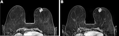 Contrast-enhanced breast MRI with gadopiclenol (0.05 mmol/kg) and gadobutrol (0.1 mmol/kg). Subtraction of axial 3-D T1-weighted dynamic contrast-enhanced MRI scans in a 55-year-old woman with invasive breast cancer, no special type; images were acquired immediately after (A) gadopiclenol administration at 0.05 mmol/kg and (B) gadobutrol administration at 0.1 mmol/kg. All images and captions courtesy of Prof. Dr. Christiane Kuhl and the RSNA.