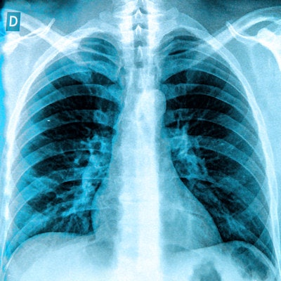 2017 03 09 14 05 24 948 Chest Lung Xray 400