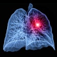 2021 02 02 17 39 1965 Lung Cancer Ct 3d 400