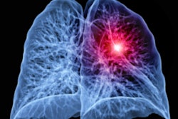 2021 02 02 17 39 1965 Lung Cancer Ct 3d 400